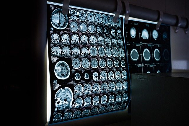 AI spots pancreatic cancer up to three years early in Mayo Clinic breakthrough